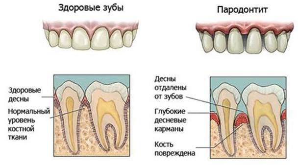 Лечение пародонтита