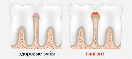 Лечение гингивита