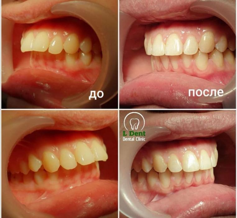 Ортодонтическое лечение в течении 11 месяцев.